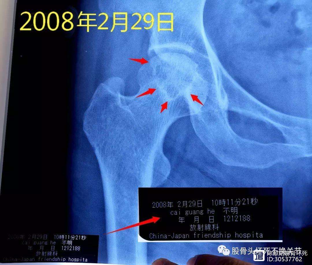 黄石人工骨头医保报销多少(人工骨头医保报销多少比例)
