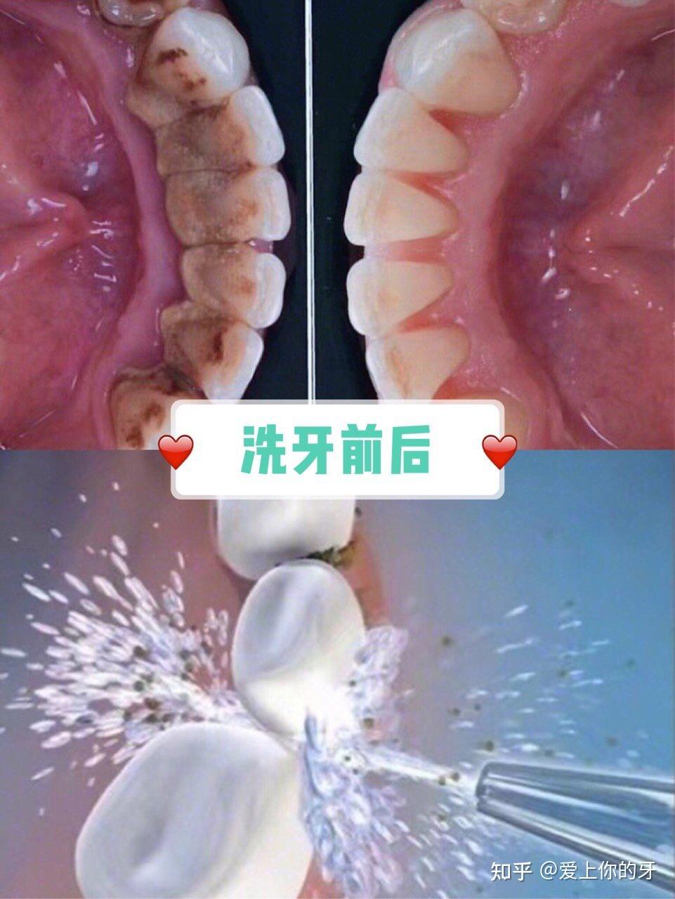 黄石洗牙可以用医保吗(洗牙可以用医保吗,报销比例多少)